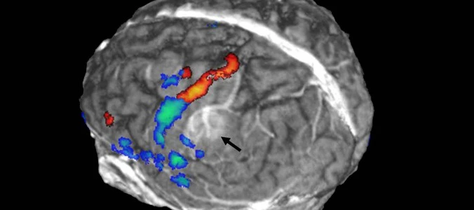 Angiografia cerebrale