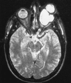 Glioma del nervo ottico - Fig. 1