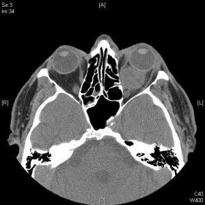 Angioma cavernoso - Fig. 1