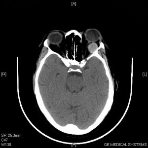 Angioma cavernoso - Fig. 2