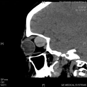 Angioma cavernoso - Fig. 3