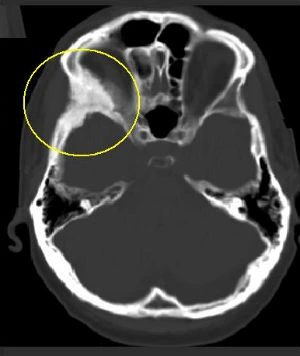 Displasia fibrosa - Fig. 1