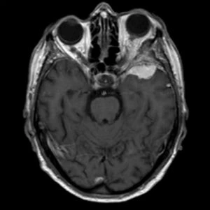 Meningioma sfeno-orbitario - Fig. 1