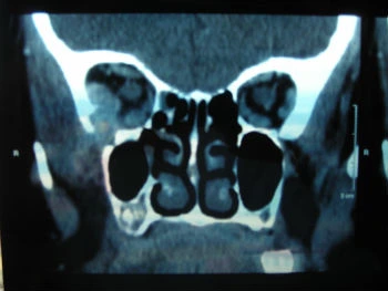 Pseudotumor infiammatorio idiopatico - Fig. 1