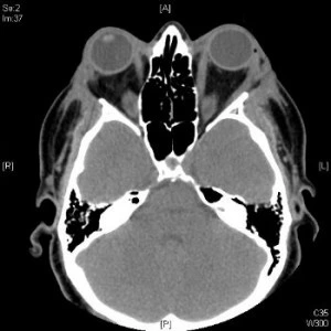 Orbitomiopatia Basedowiana - Fig. 2